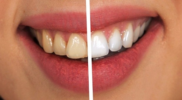 Twenty Dental Care Gosport Hampshire teeth whitening before after